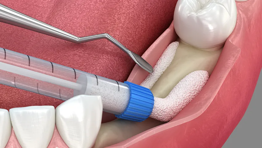 Kemik Yetersizliklerinde implant Tedavisi Kırklareli Diş Kliniği Atlas Sea Dental