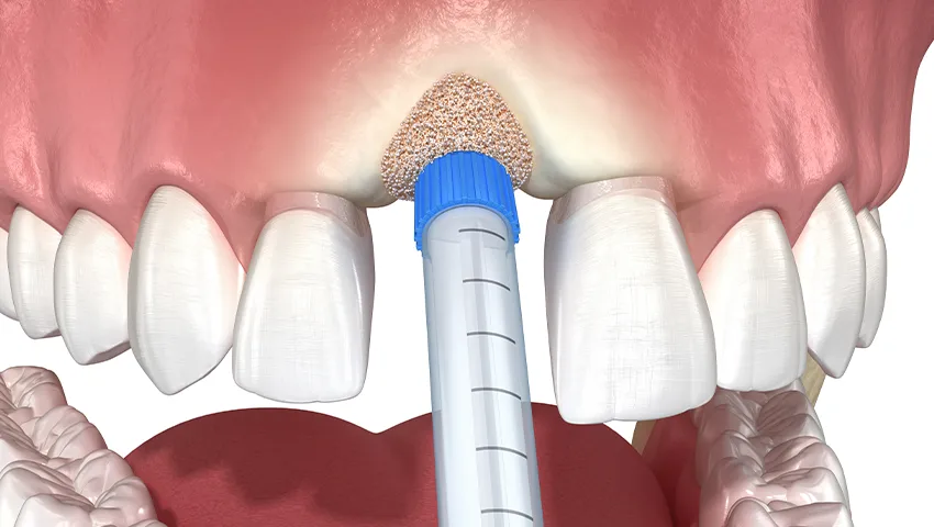 Kemik Yetersizliklerinde implant Tedavisi Kırklareli Diş Kliniği Atlas Sea Dental