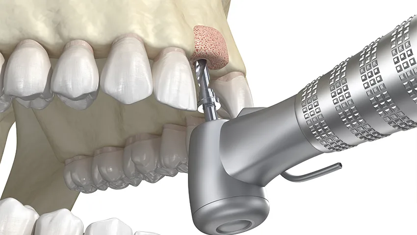 Kemik Yetersizliklerinde implant Tedavisi Kırklareli Diş Kliniği Atlas Sea Dental