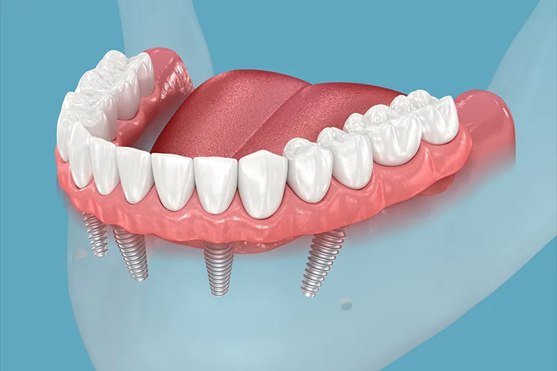 Импланти All On Four, , All On Four Implant