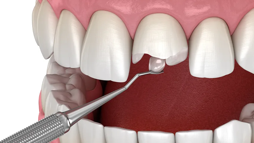 Bonding Dolgu , Kırklareli Diş Kliniği Atlas Sea Dental