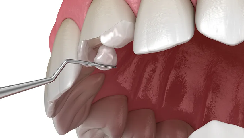 Bonding Dolgu , Kırklareli Diş Kliniği Atlas Sea Dental