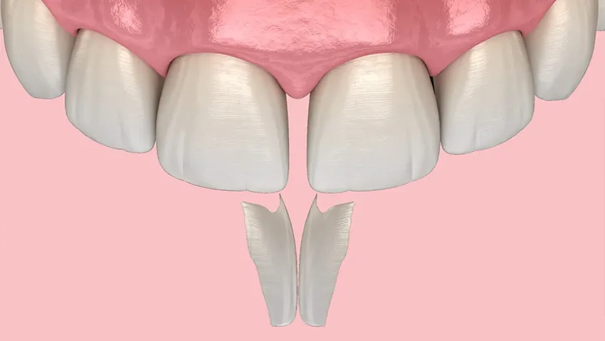 diestema bonding , Kırklareli Diş Kliniği Atlas Sea Dental