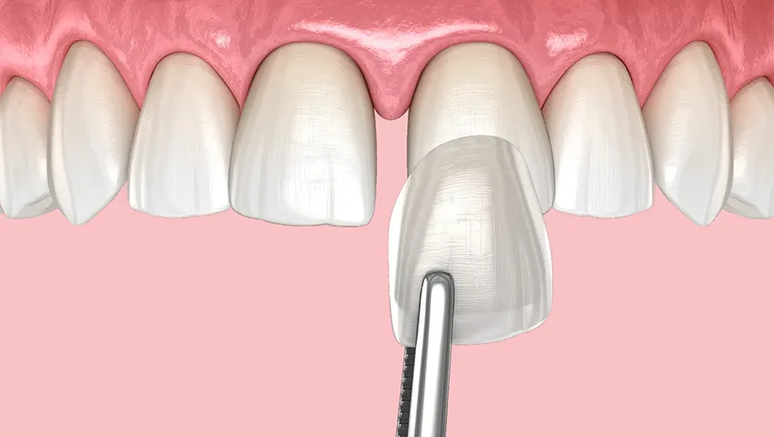 diestema lamina , Kırklareli Diş Kliniği Atlas Sea Dental