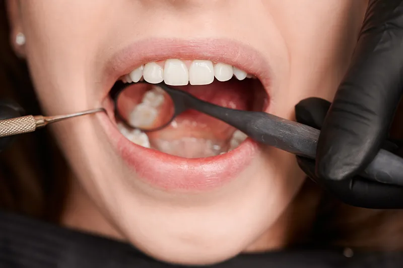 Зъбни Пломби