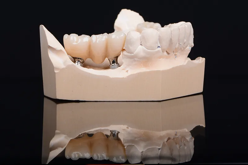 Протези върху импланти , Implant Supported Prostheses