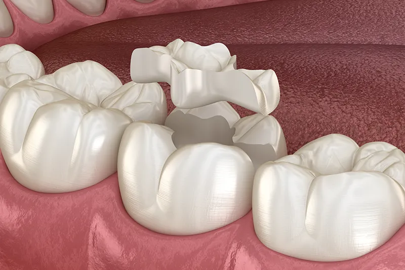 Порцеланови Пломби , Porcelain Fillings - Kırklareli Dental Clinic Atlas Sea