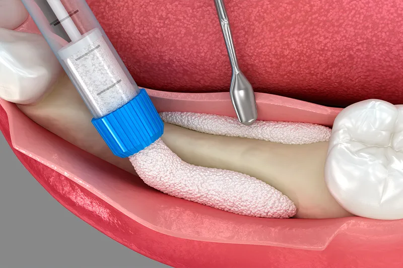 Kemik Yetersizliklerinde İmplant Tedavisi Kırklareli Diş Kliniği Atlas Sea Dental