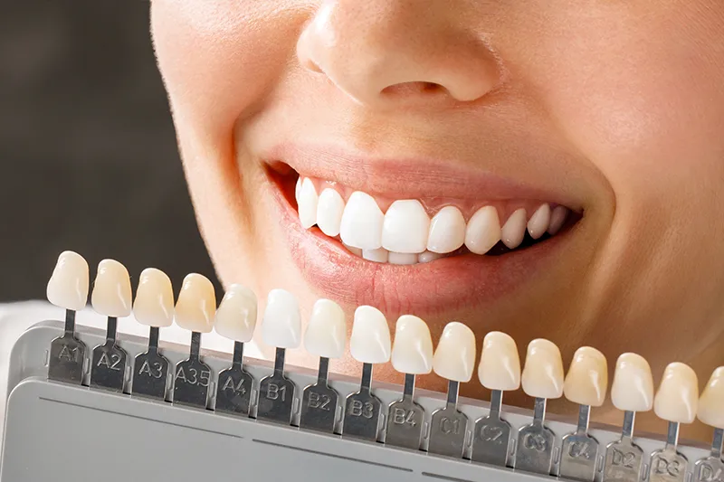 Porselen Lamina Kaplama , Atlas Sea Dental Diş Kliniği Kırklareli