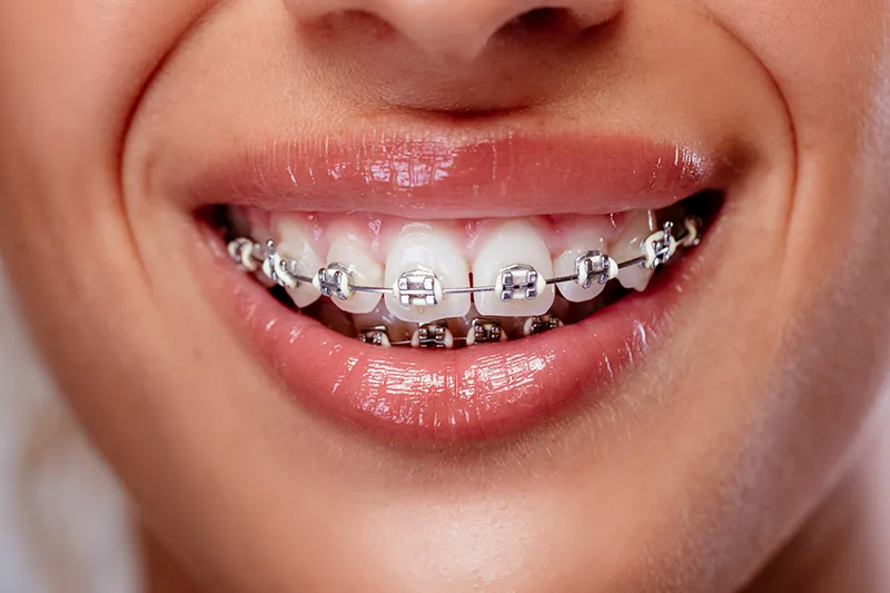 Ортодонтско лечение , Kırklareli Dental Clinic Atlas Sea