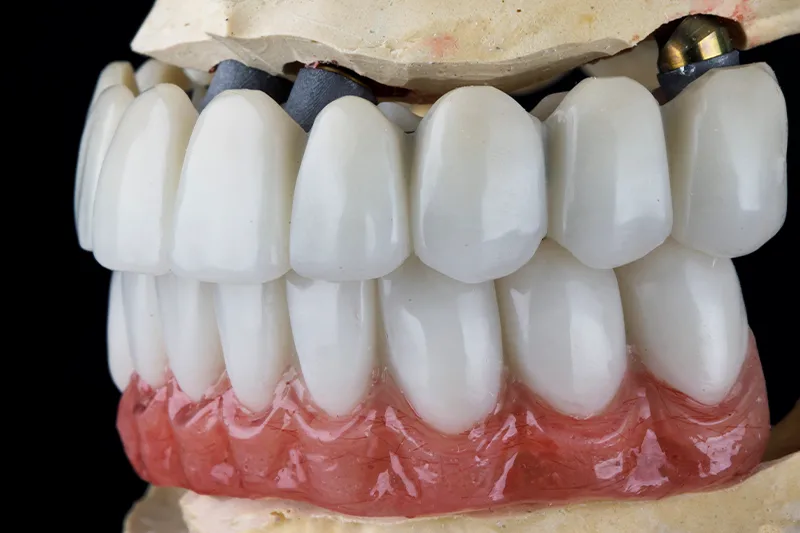Zirkonyum Diş , zirkonyum diş kaplama , Kırklareli Diş Kliniği Atlas Sea Dental