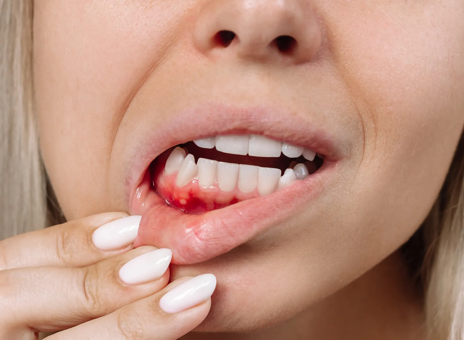 Diş eti kanaması , Kırklareli Diş Kliniği , Atlas Sea Dental