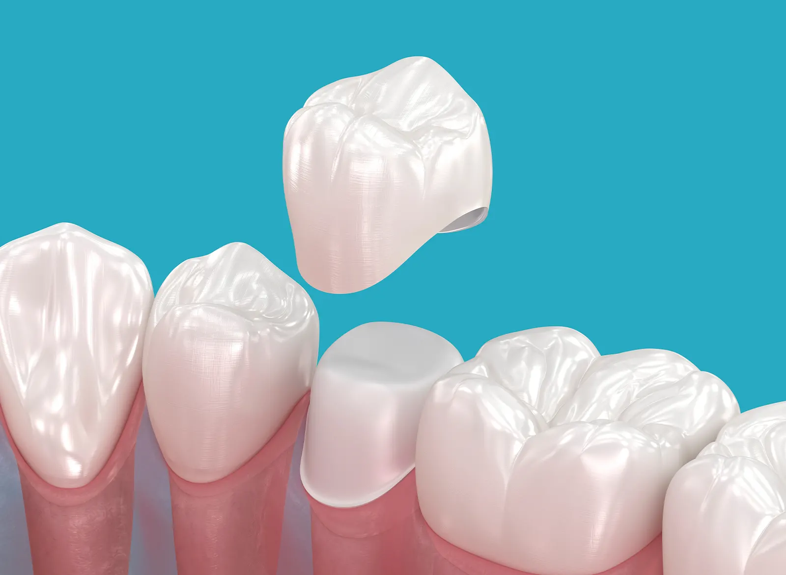 Diş Kaplama , Kırklareli Diş Kliniği , Atlas Sea Dental